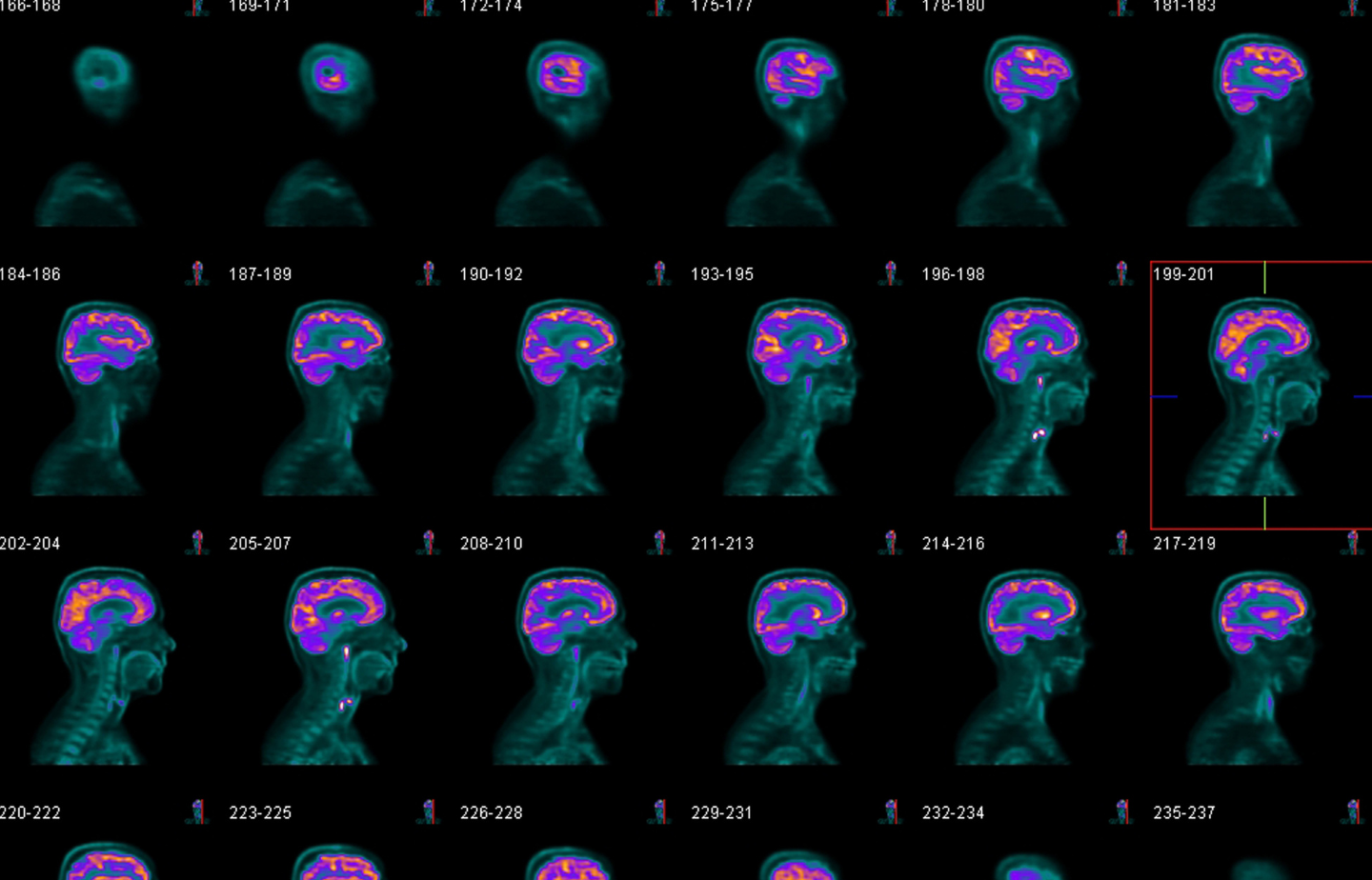 בדיקת PET CT פרטי